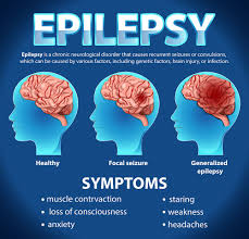 How Seizures and Epilepsy Affect Brain Function and Overall Health